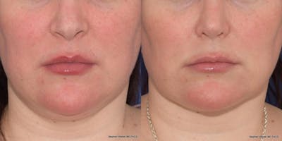 Buccal Fat Removal Before & After Gallery - Patient 268623 - Image 1