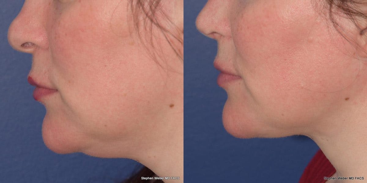 Buccal Fat Removal Before & After Gallery - Patient 268623 - Image 2