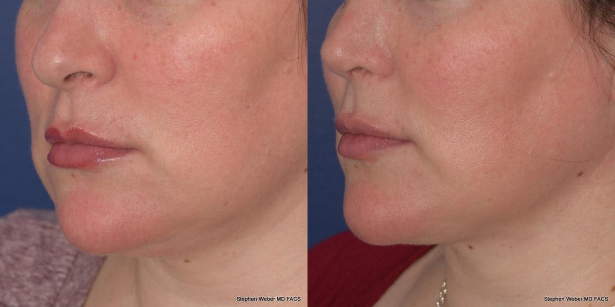 Buccal Fat Removal Before & After Gallery - Patient 268623 - Image 3