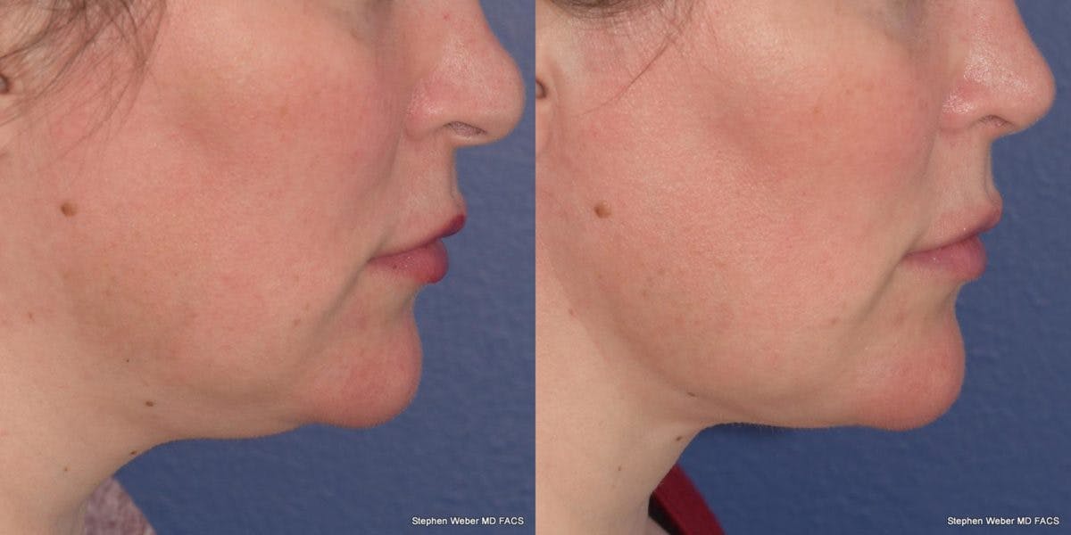 Buccal Fat Removal Before & After Gallery - Patient 268623 - Image 4