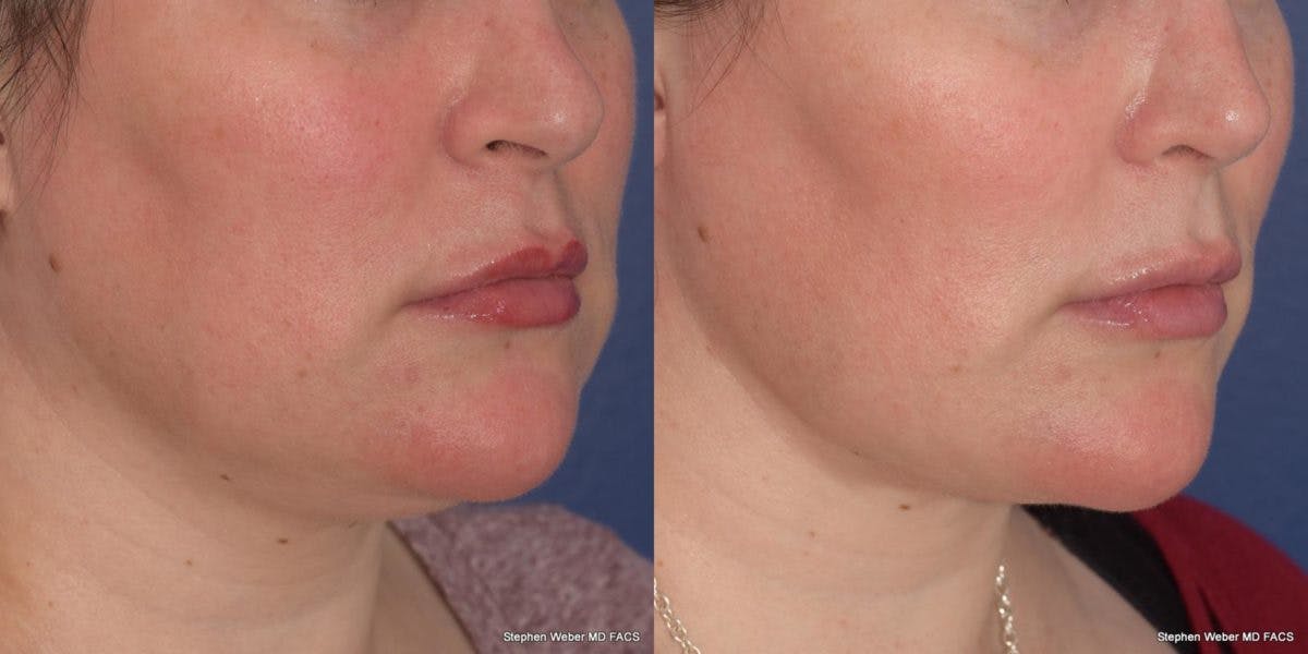 Buccal Fat Removal Before & After Gallery - Patient 268623 - Image 5
