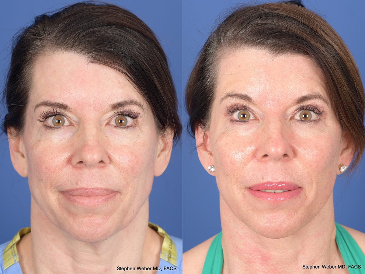 Cheek Implant Before & After Gallery - Patient 184337 - Image 1