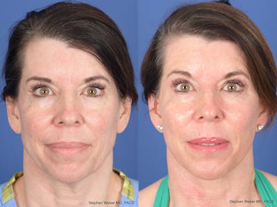 Cheek Implant Before & After Gallery - Patient 184337 - Image 1