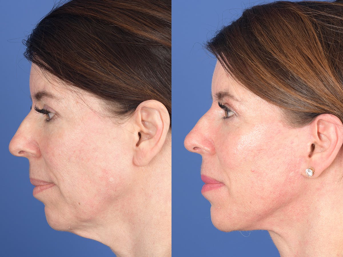 Cheek Implant Before & After Gallery - Patient 184337 - Image 2