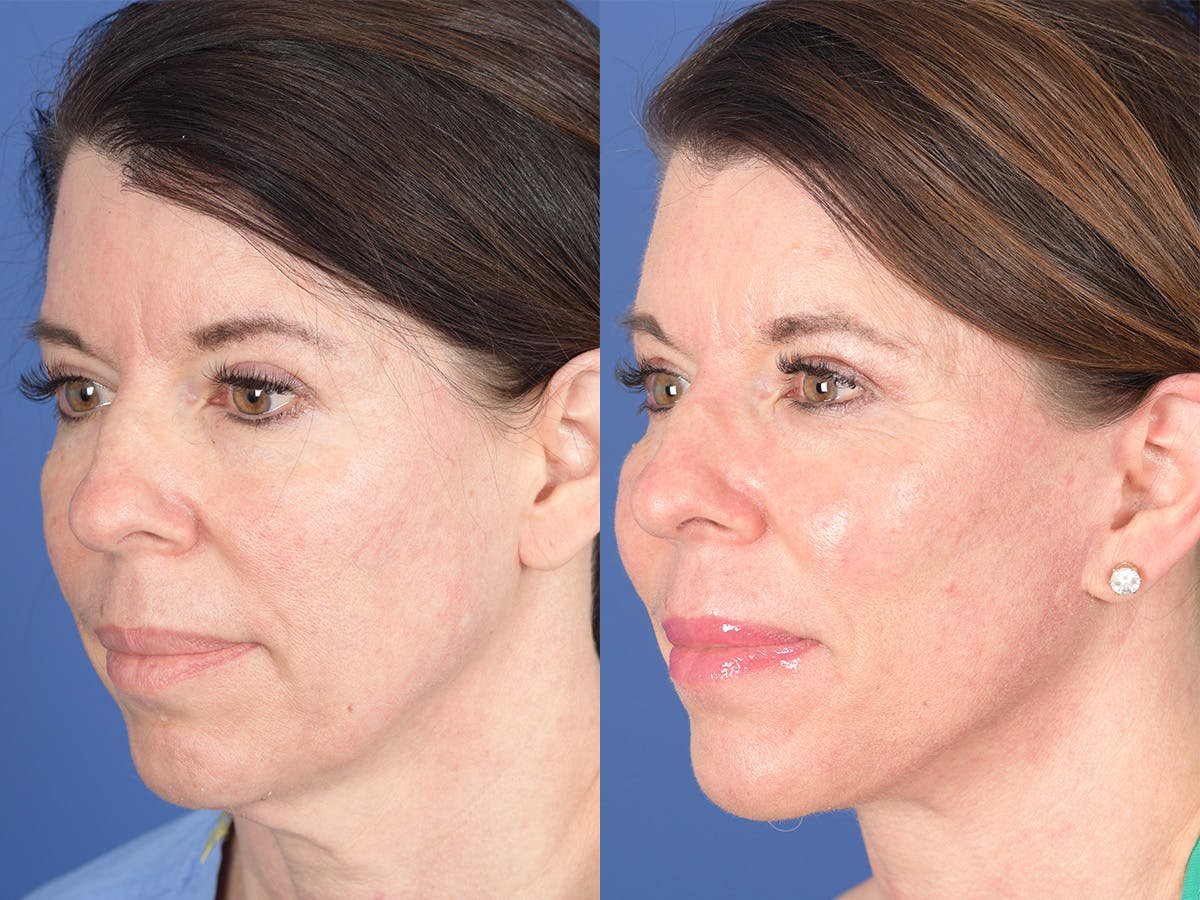 Cheek Implant Before & After Gallery - Patient 184337 - Image 3