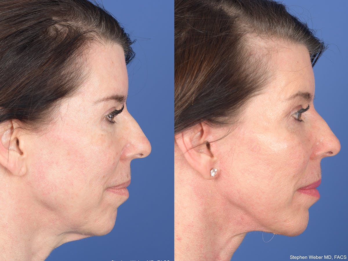 Cheek Implant Before & After Gallery - Patient 184337 - Image 4