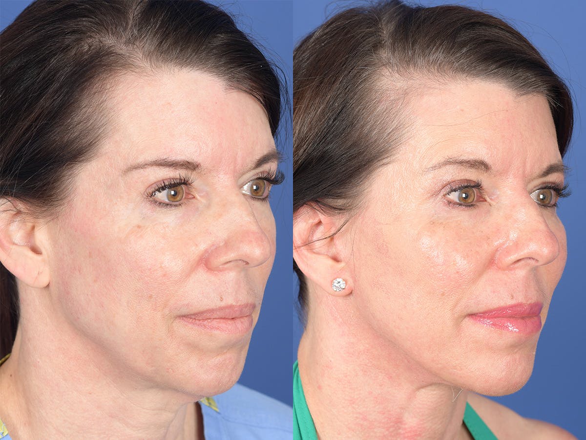 Cheek Implant Before & After Gallery - Patient 184337 - Image 5