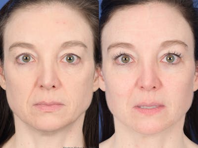 Cheek Implant Before & After Gallery - Patient 368592 - Image 1