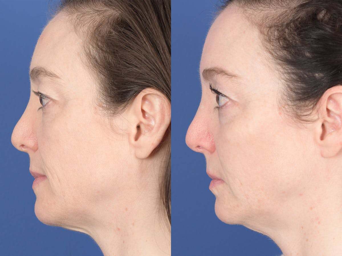 Cheek Implant Before & After Gallery - Patient 368592 - Image 2