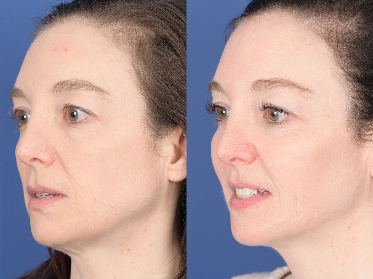 Cheek Implant Before & After Gallery - Patient 368592 - Image 3