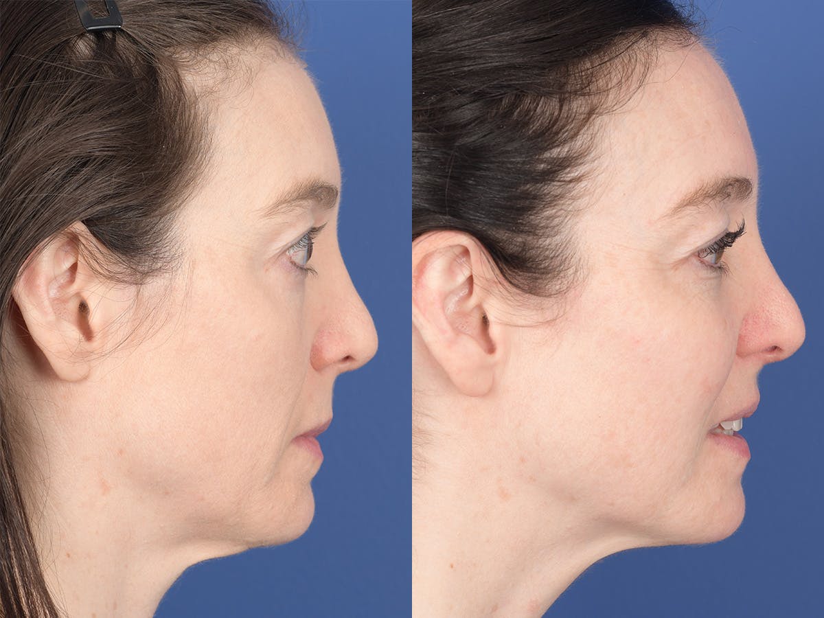 Cheek Implant Before & After Gallery - Patient 368592 - Image 4