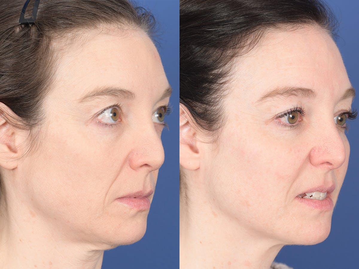 Cheek Implant Before & After Gallery - Patient 368592 - Image 5