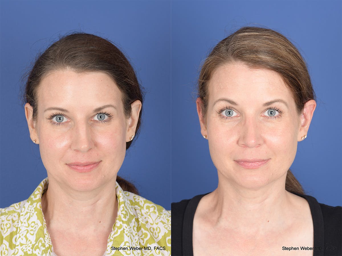 Cheek Implant Before & After Gallery - Patient 403229 - Image 1