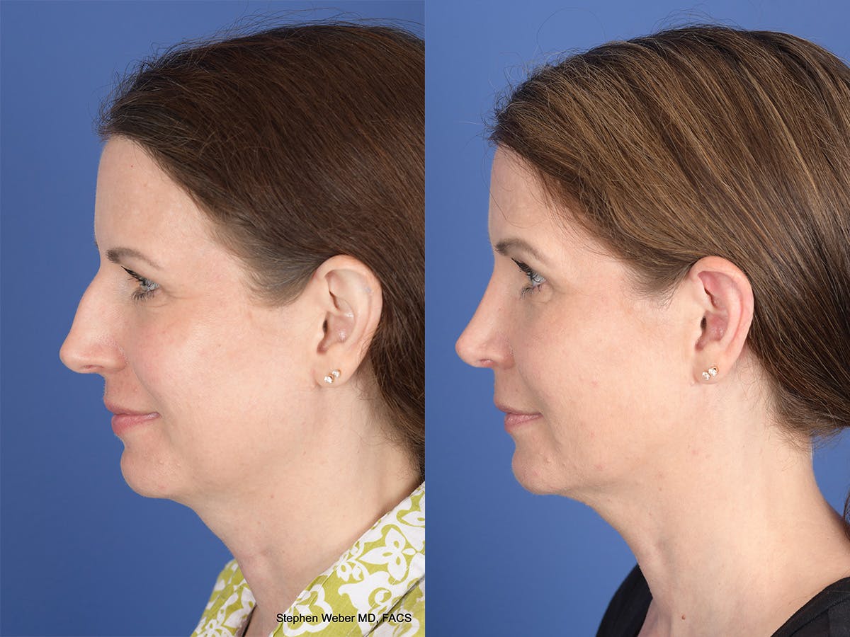 Cheek Implant Before & After Gallery - Patient 403229 - Image 2