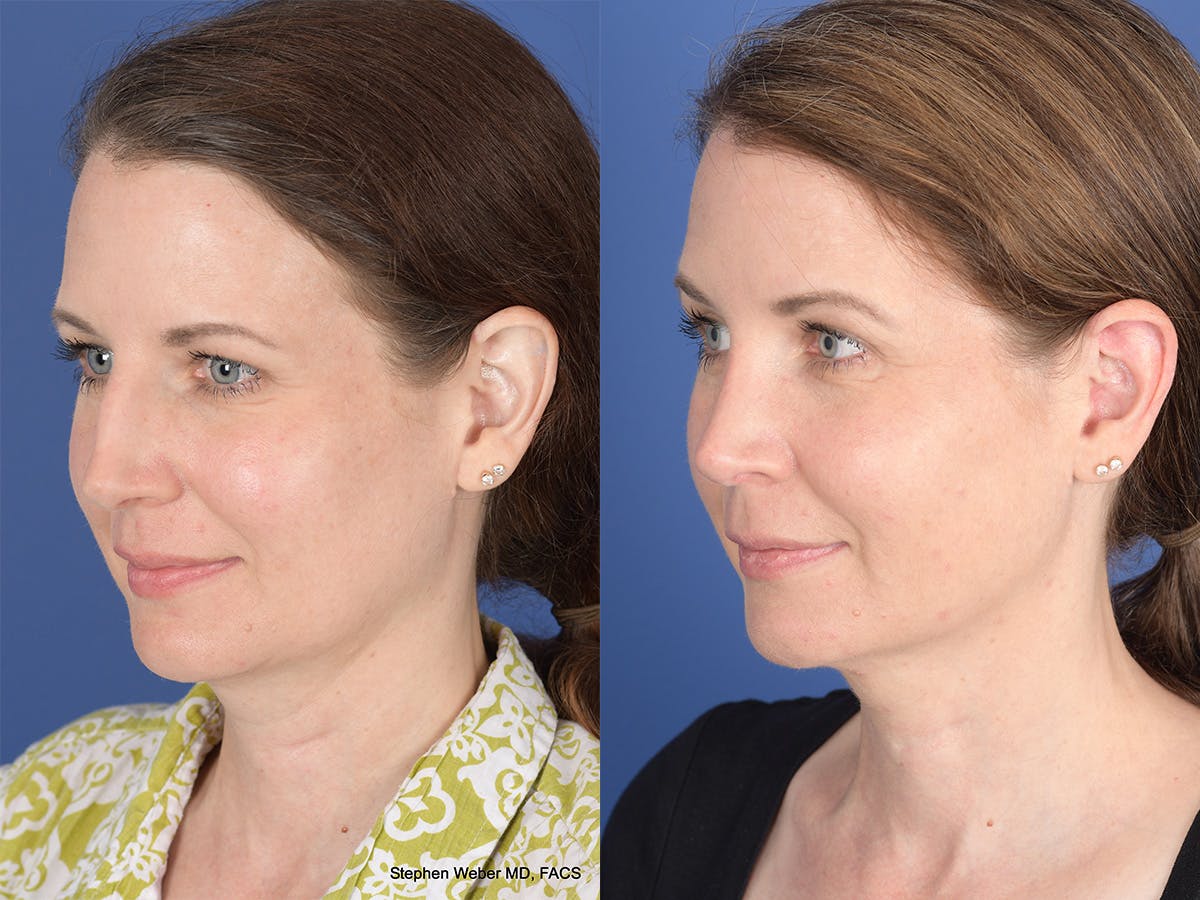 Cheek Implant Before & After Gallery - Patient 403229 - Image 3