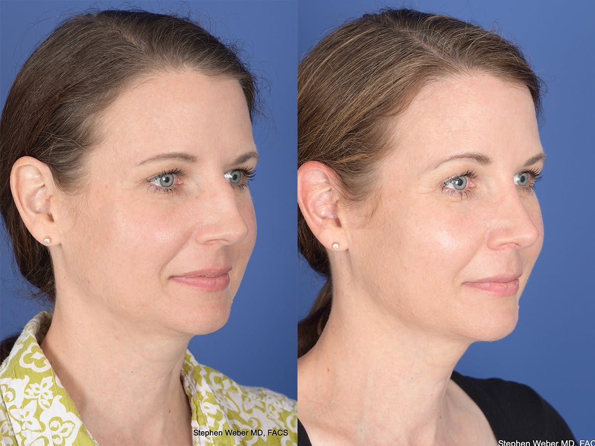 Cheek Implant Before & After Gallery - Patient 403229 - Image 4