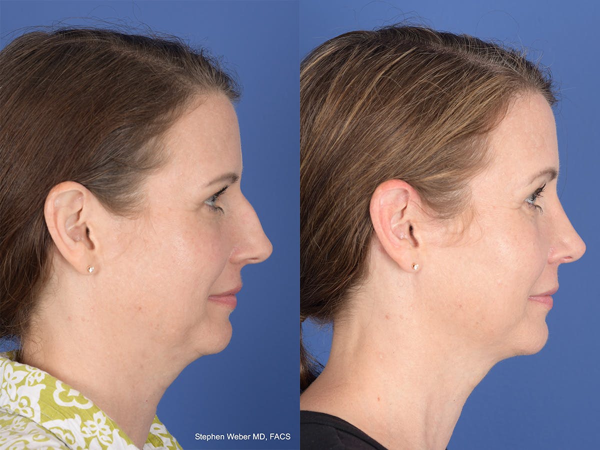 Cheek Implant Before & After Gallery - Patient 403229 - Image 5
