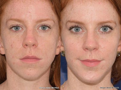 Cheek Implant Before & After Gallery - Patient 334130 - Image 1