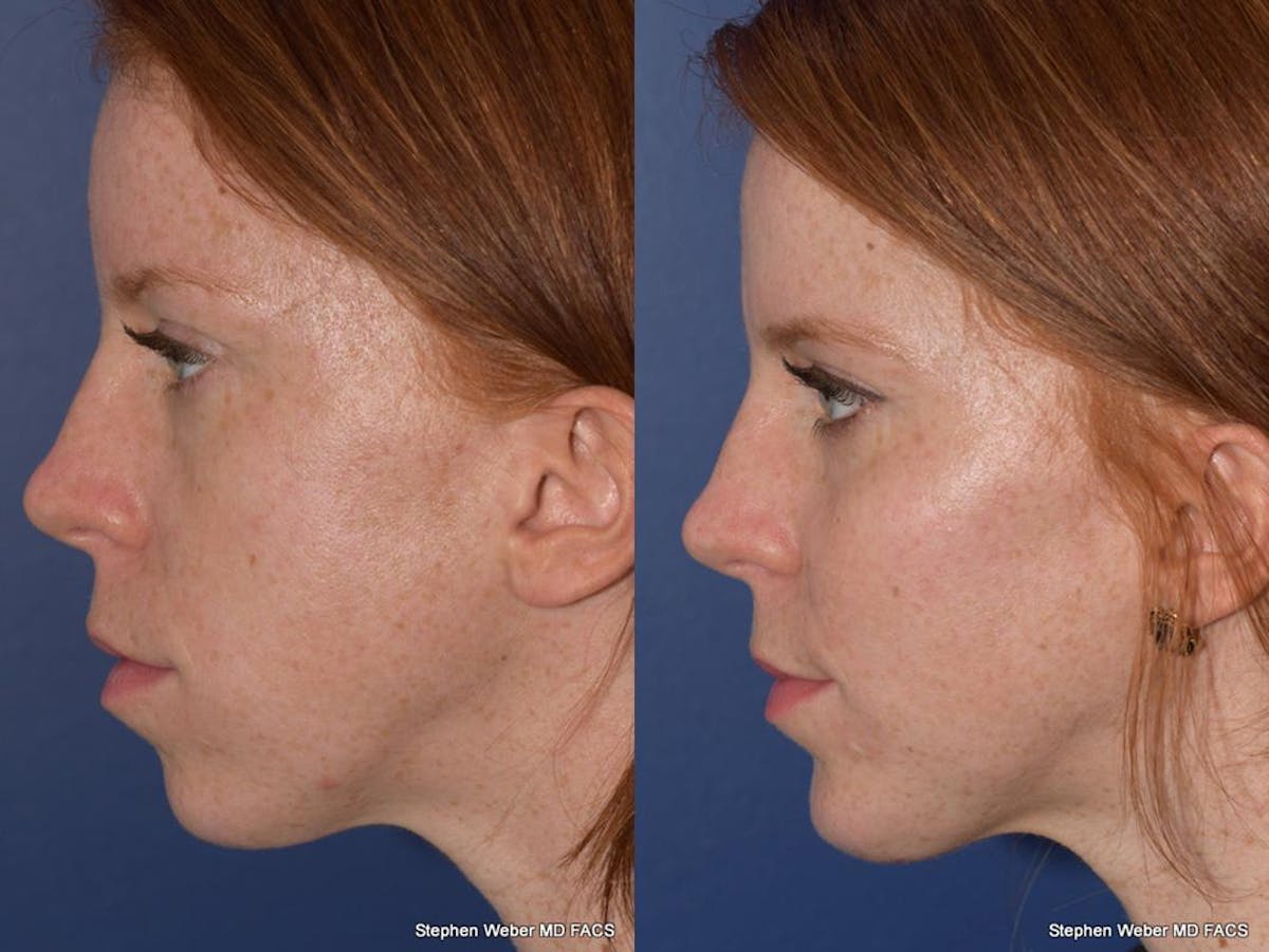 Cheek Implant Before & After Gallery - Patient 334130 - Image 2