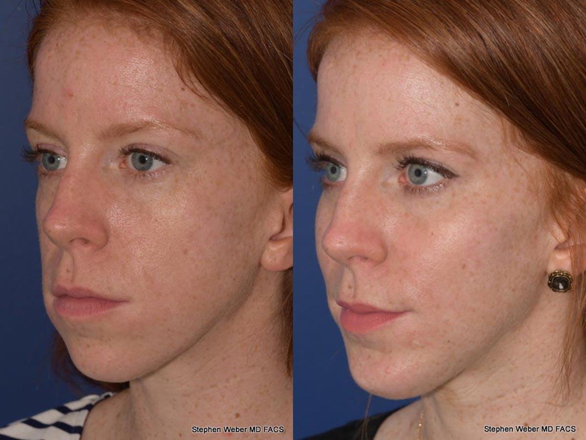 Cheek Implant Before & After Gallery - Patient 334130 - Image 3