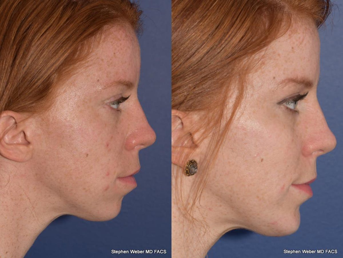 Cheek Implant Before & After Gallery - Patient 334130 - Image 4