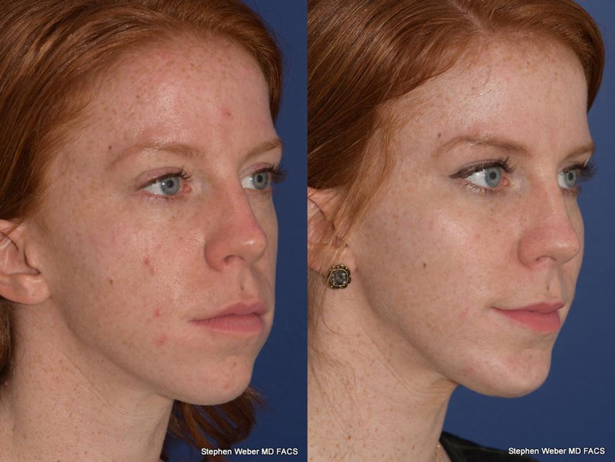 Cheek Implant Before & After Gallery - Patient 334130 - Image 5