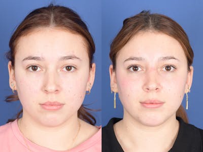 Rhinoplasty Before & After Gallery - Patient 246851 - Image 1