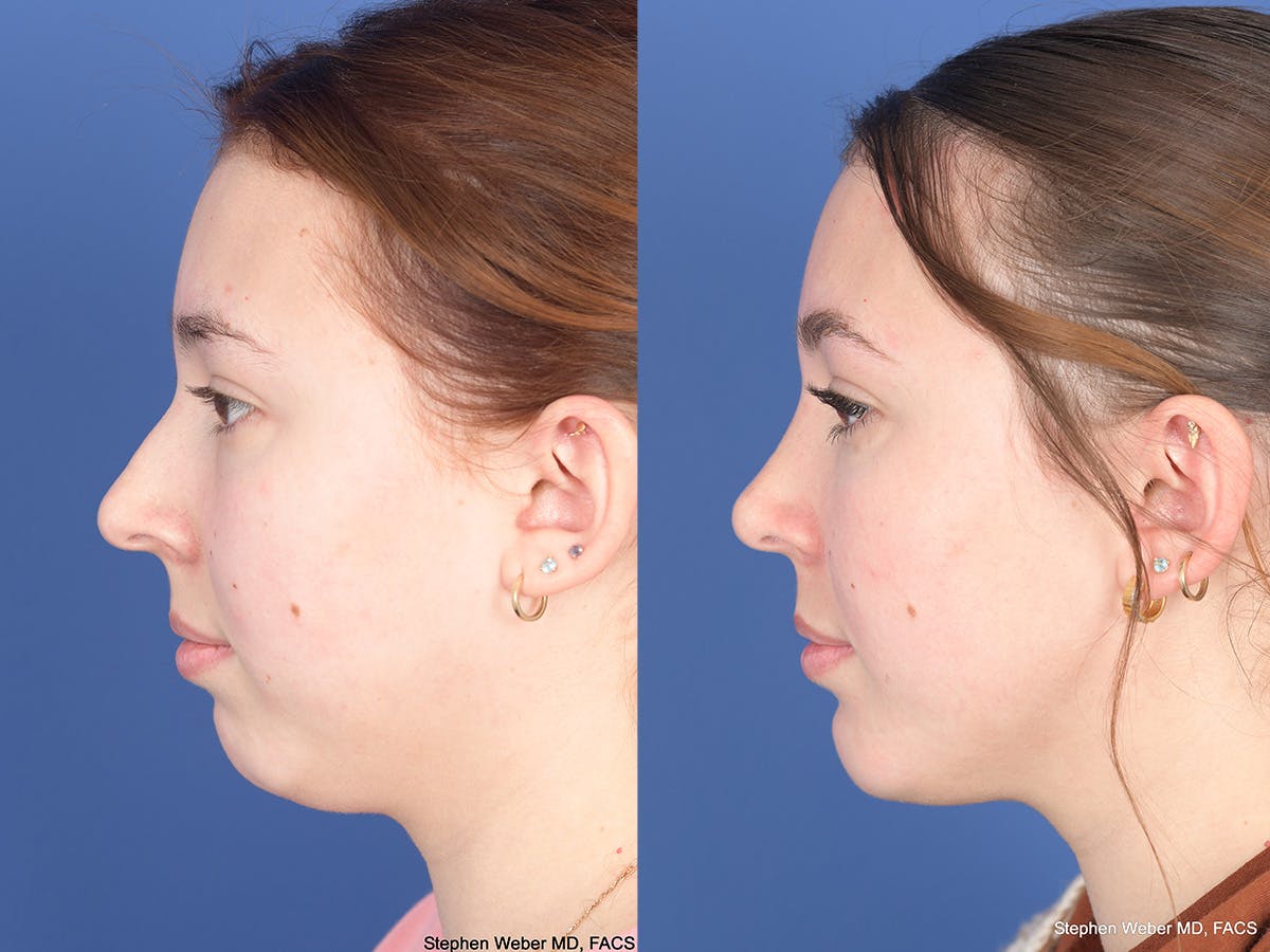 Chin Implant Before & After Gallery - Patient 894285 - Image 2