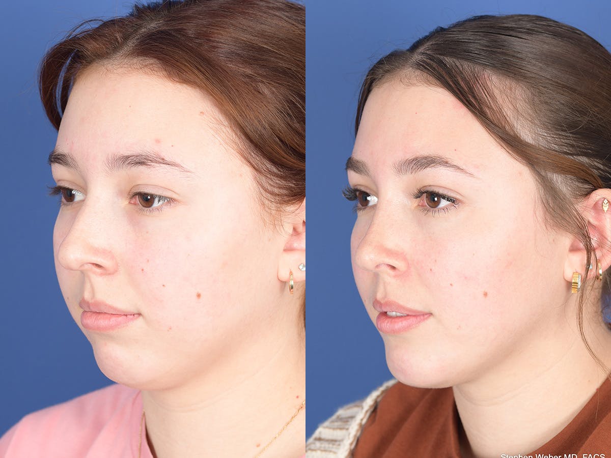 Chin Implant Before & After Gallery - Patient 894285 - Image 3