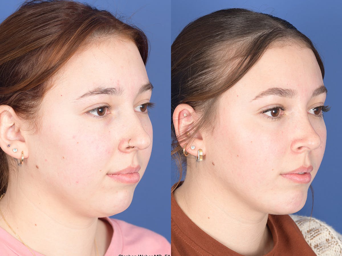 Chin Implant Before & After Gallery - Patient 894285 - Image 4