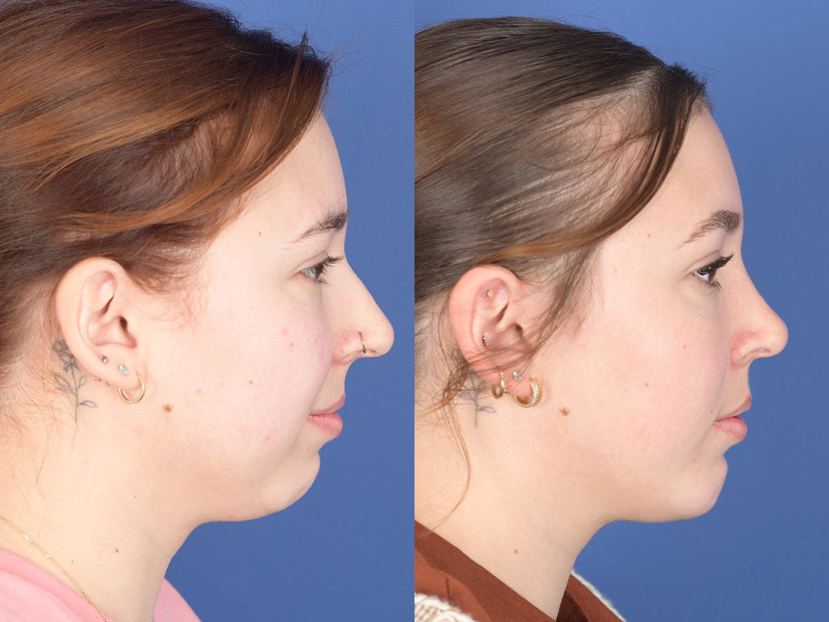 Chin Implant Before & After Gallery - Patient 894285 - Image 5