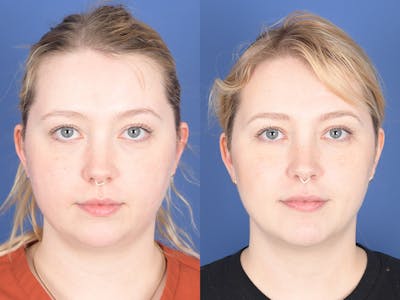 Chin Implant Before & After Gallery - Patient 412684 - Image 1