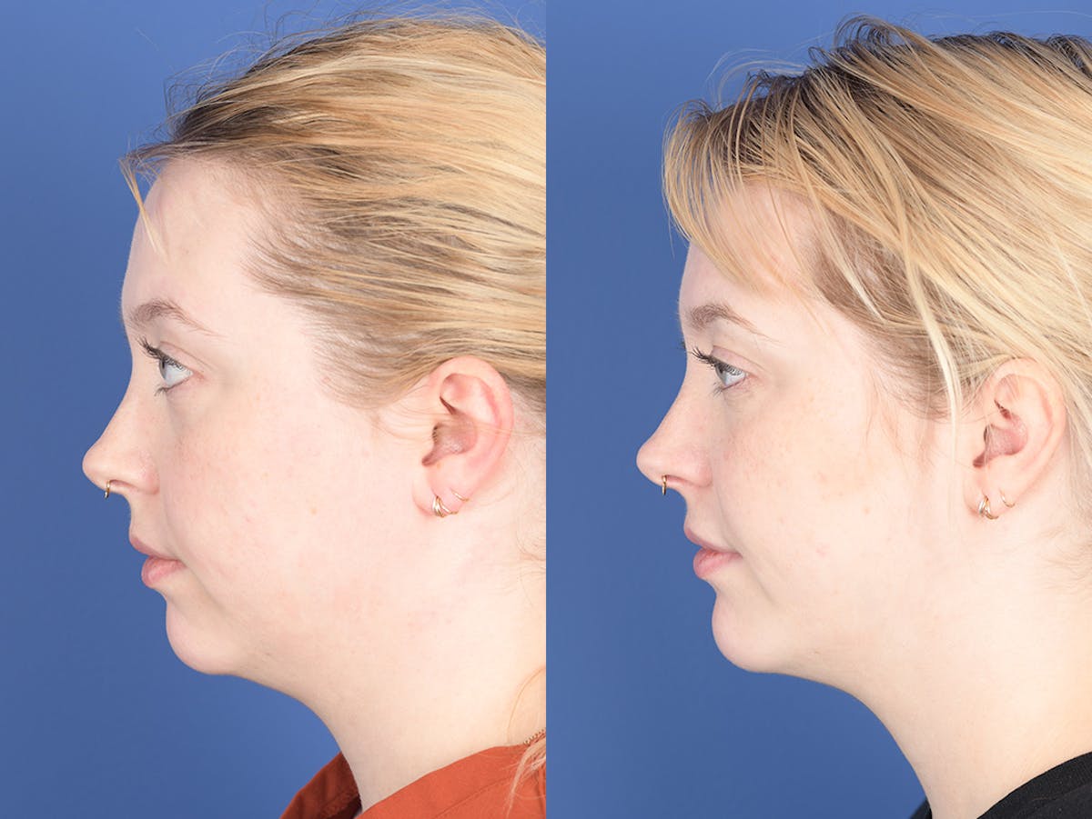 Chin Implant Before & After Gallery - Patient 412684 - Image 2