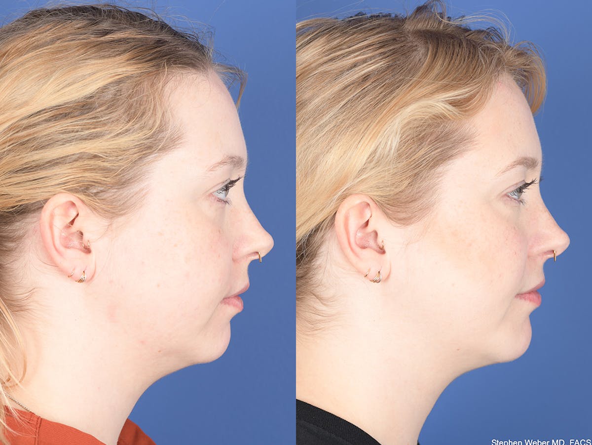 Chin Implant Before & After Gallery - Patient 412684 - Image 4