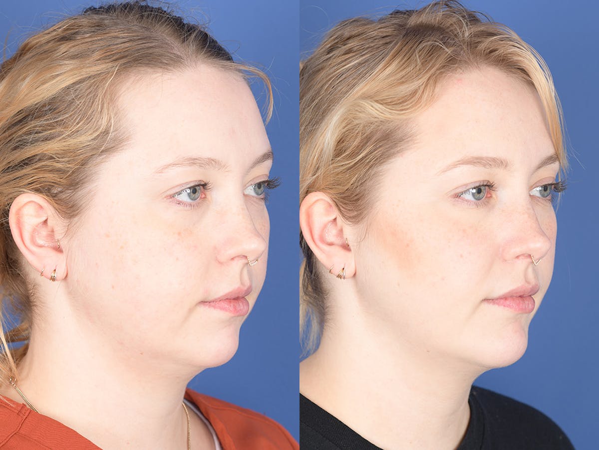 Chin Implant Before & After Gallery - Patient 412684 - Image 5