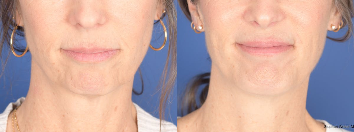 Chin Implant Before & After Gallery - Patient 175375 - Image 1