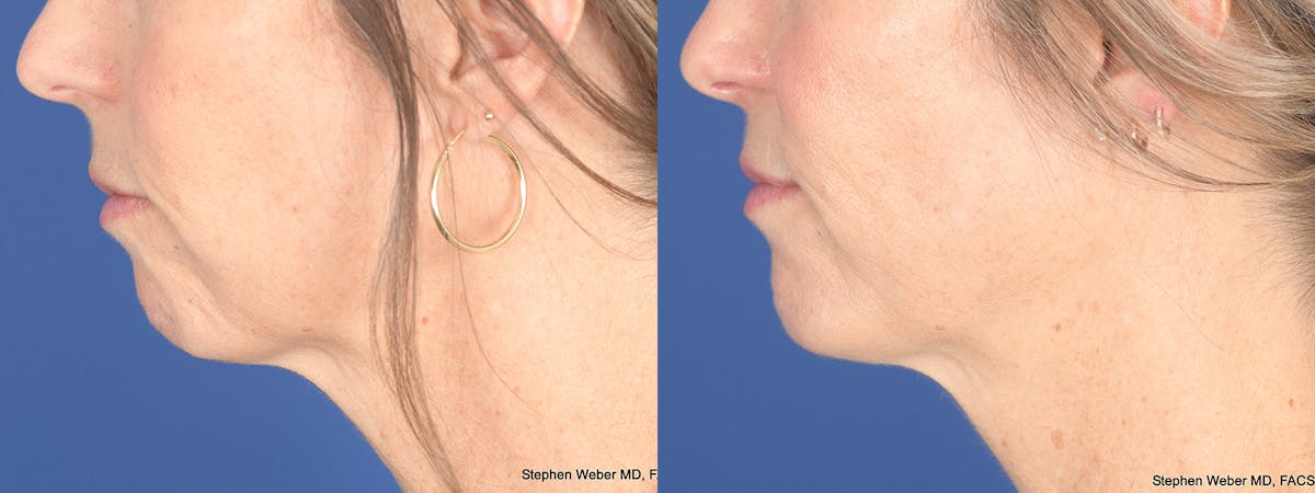 Chin Implant Before & After Gallery - Patient 175375 - Image 2