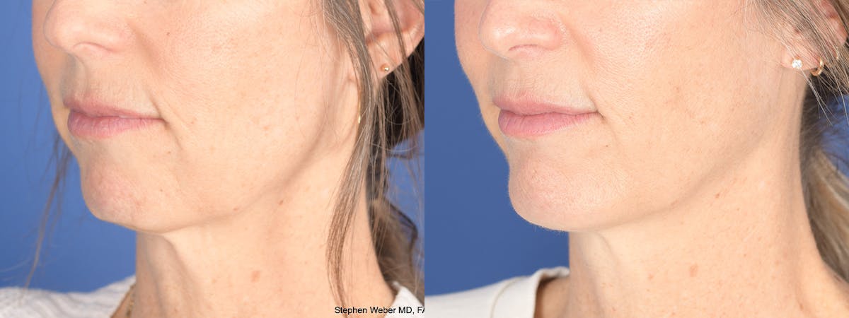 Chin Implant Before & After Gallery - Patient 175375 - Image 3