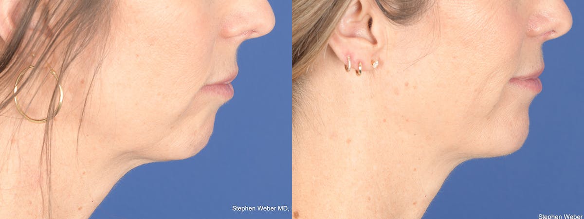 Chin Implant Before & After Gallery - Patient 175375 - Image 4