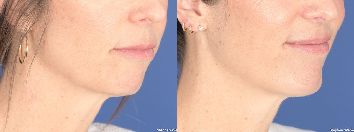 Chin Implant Before & After Gallery - Patient 175375 - Image 5