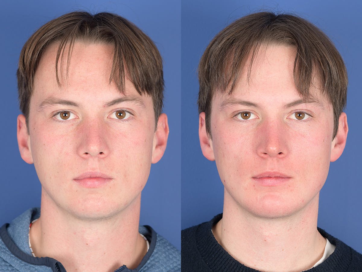 Chin Implant Before & After Gallery - Patient 254317 - Image 1