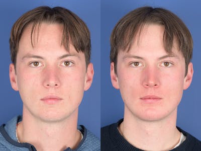 Chin Implant Before & After Gallery - Patient 254317 - Image 1