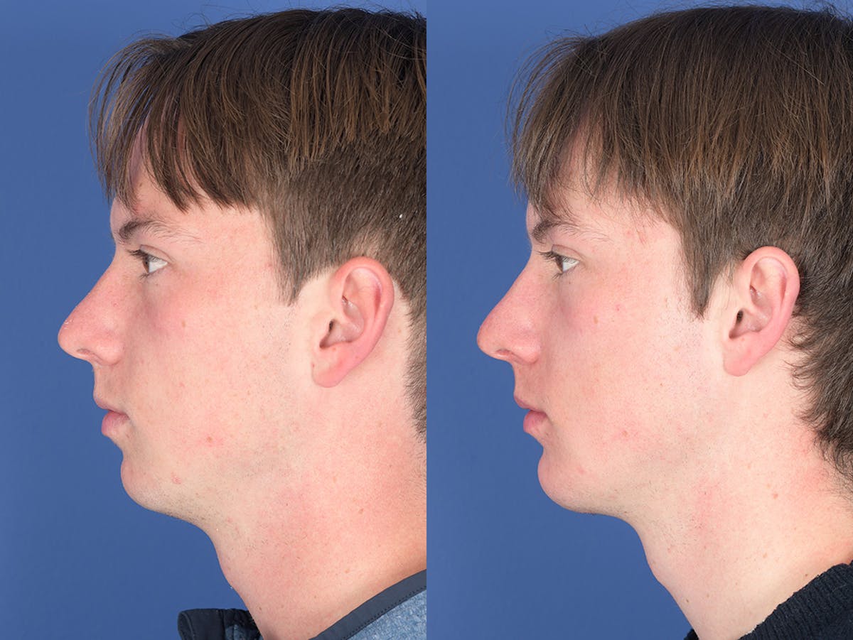 Chin Implant Before & After Gallery - Patient 254317 - Image 2