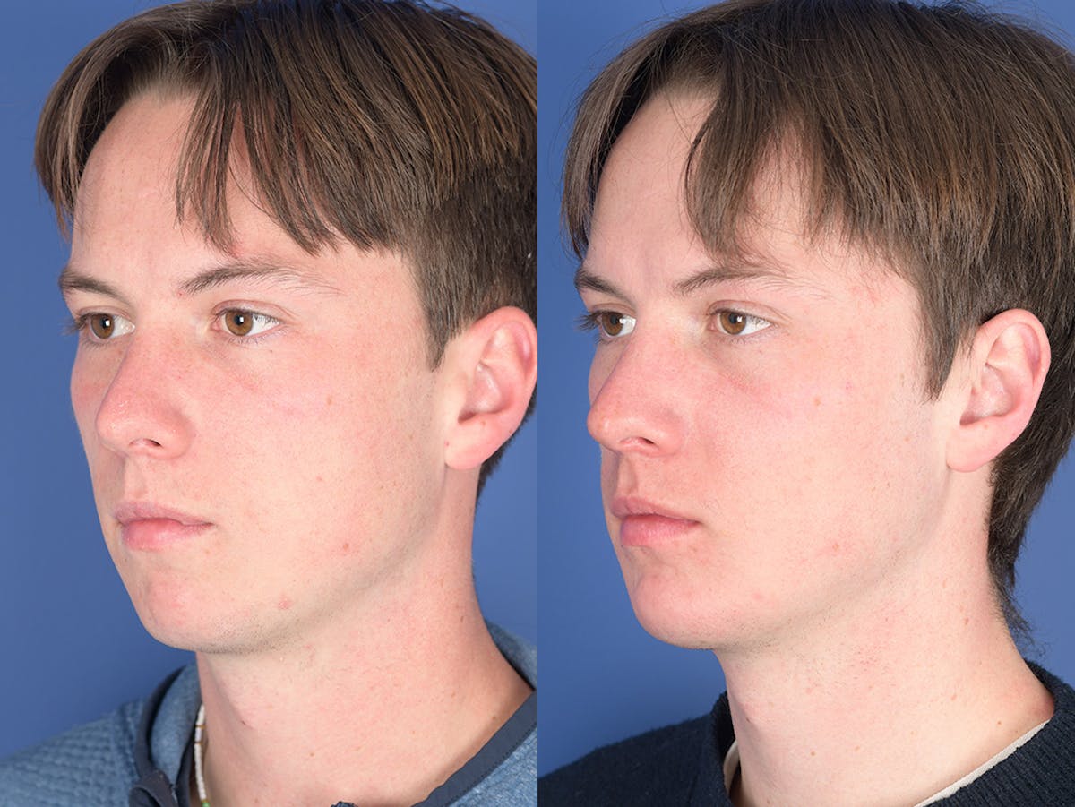 Chin Implant Before & After Gallery - Patient 254317 - Image 3