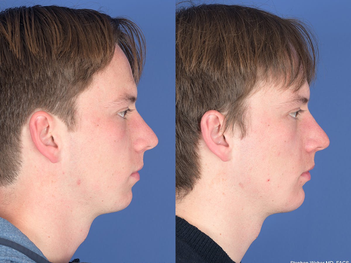 Chin Implant Before & After Gallery - Patient 254317 - Image 4