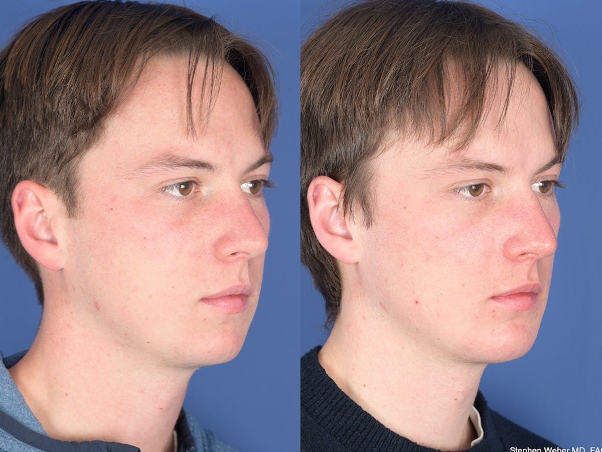 Chin Implant Before & After Gallery - Patient 254317 - Image 5