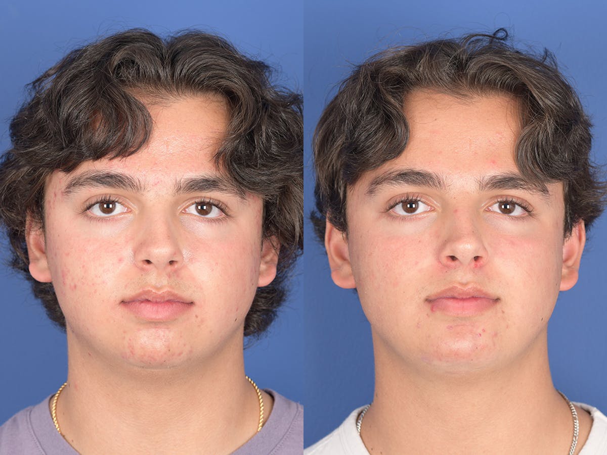 Chin Implant Before & After Gallery - Patient 320646 - Image 1