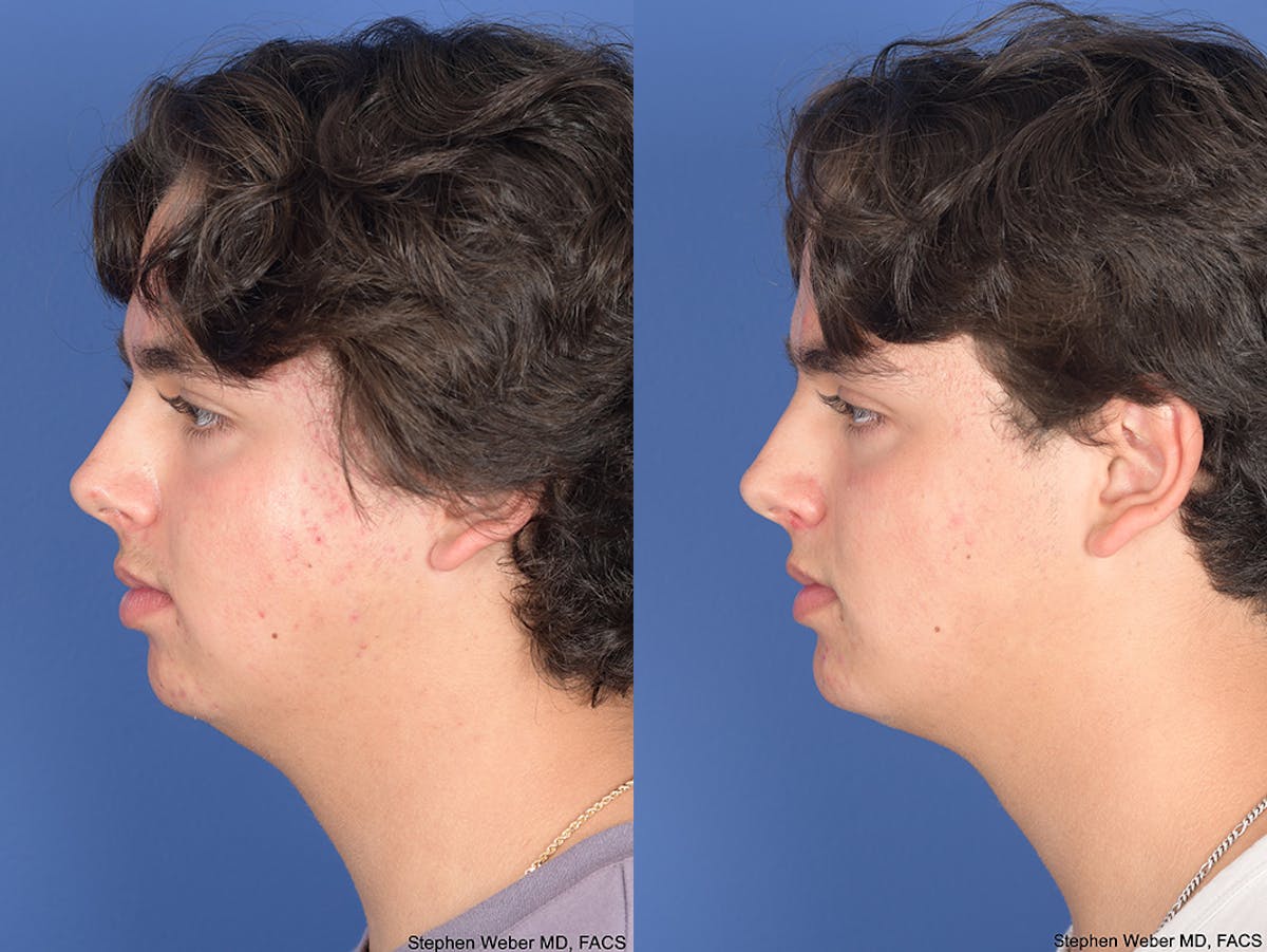 Chin Implant Before & After Gallery - Patient 320646 - Image 2