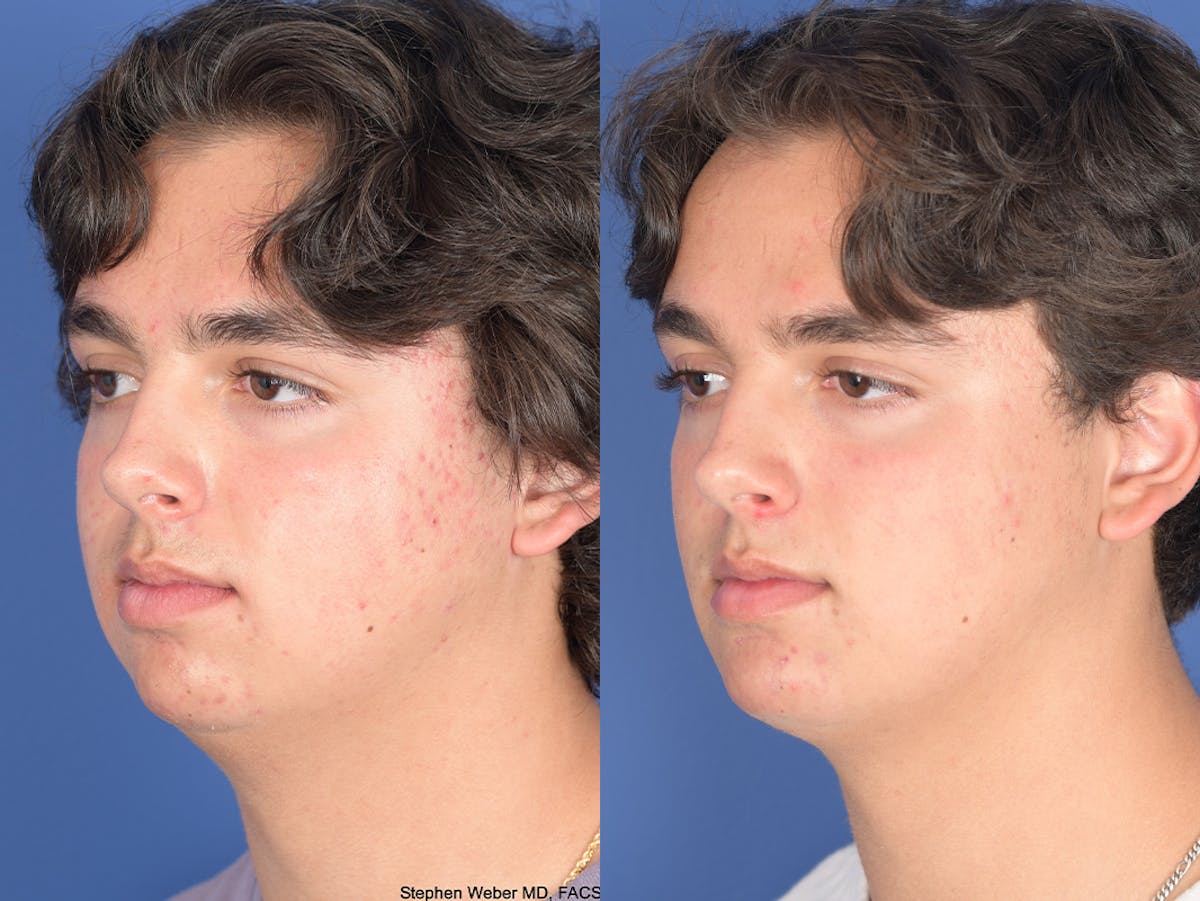 Chin Implant Before & After Gallery - Patient 320646 - Image 3