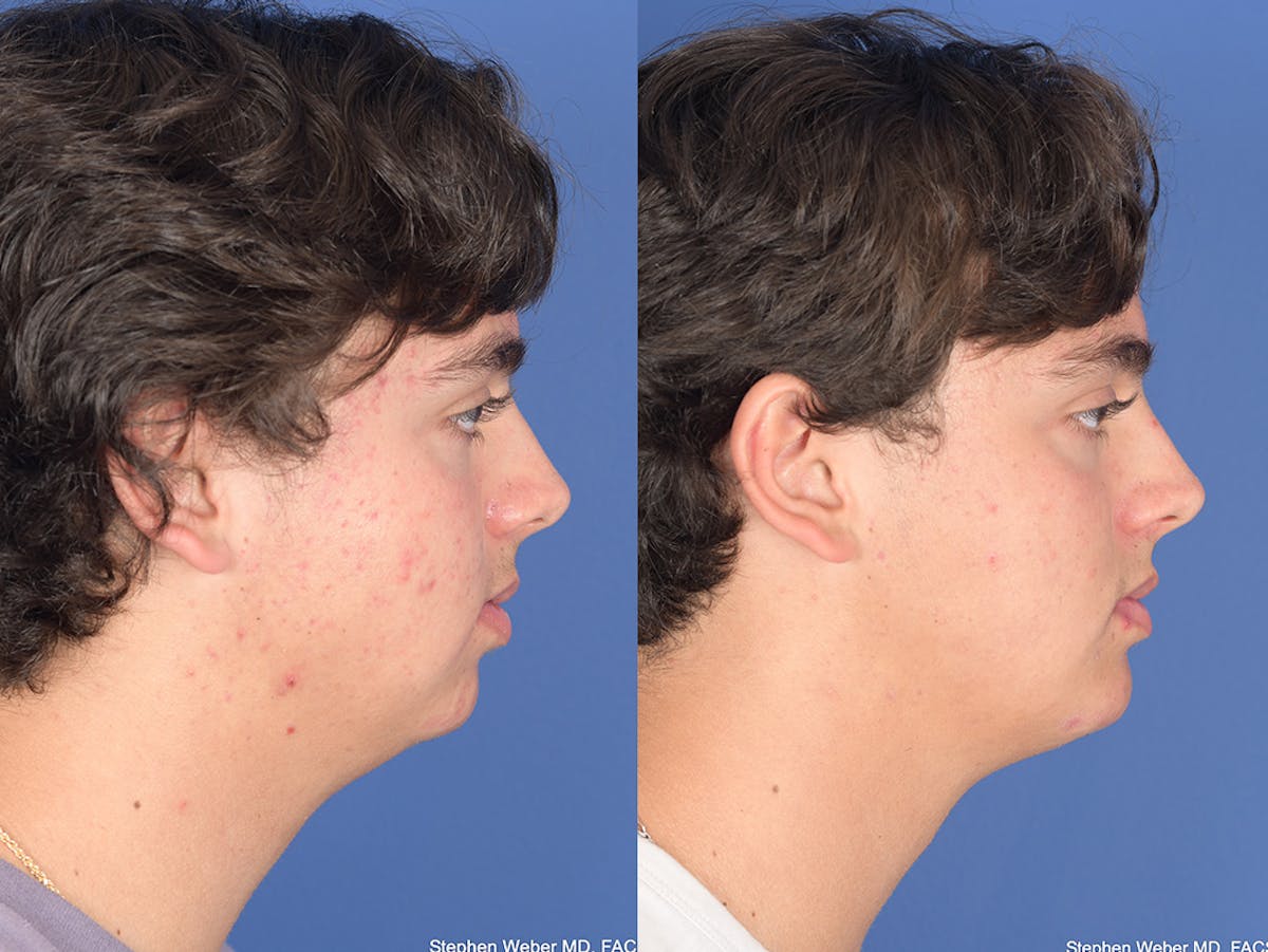 Chin Implant Before & After Gallery - Patient 320646 - Image 4